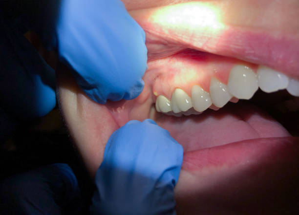 Best Emergency Treatment for Dental Infections or Abscesses in Middle River, MD